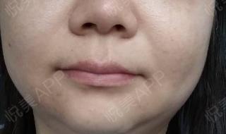 去眼袋手术费用一般要多少 做去眼袋手术多少钱